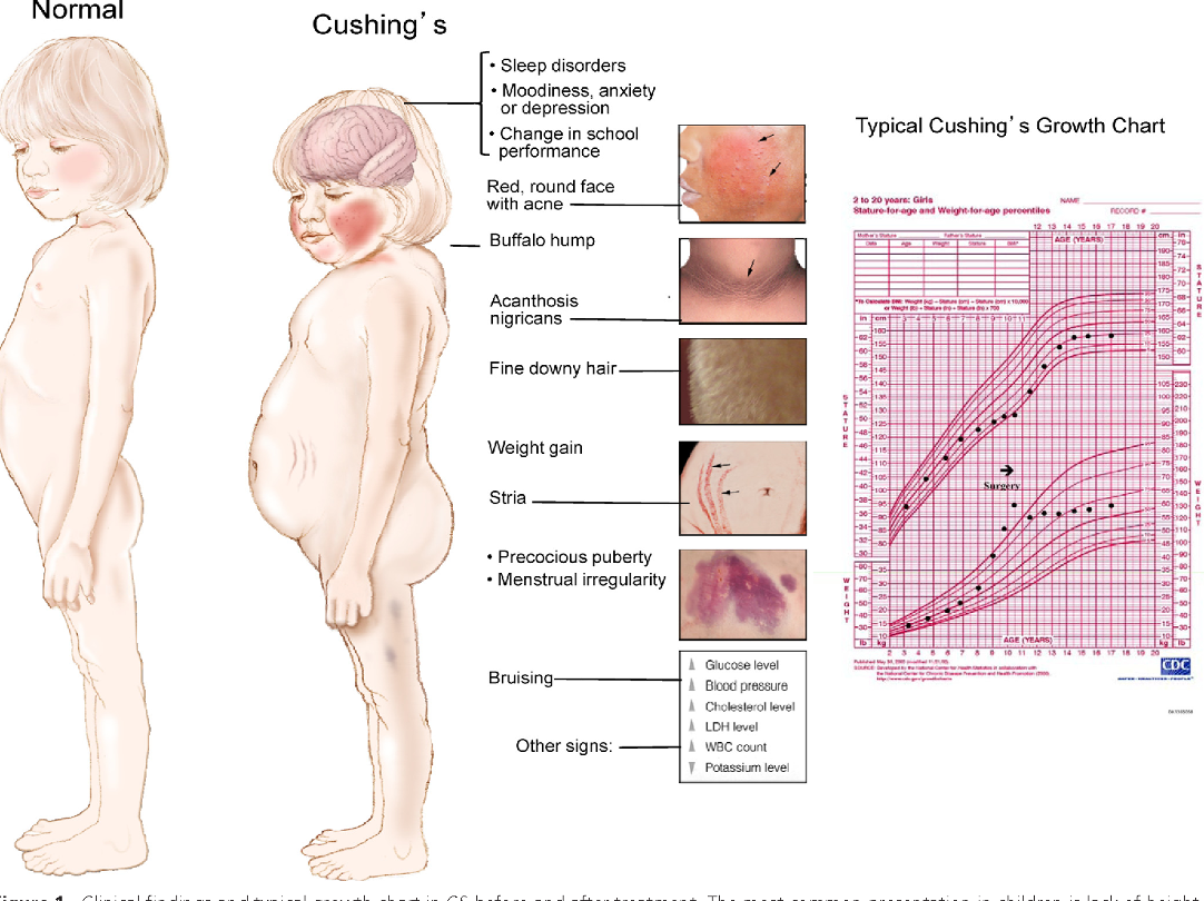 <p>condition from <span class="tt-bg-yellow">high cortisol levels</span>; caused by use of steroids or overproduction by adrenal glands</p><p>-red round face</p><p>-hunch back(buffalo hump)</p><p>-carry fat in stomach (bulging0</p>