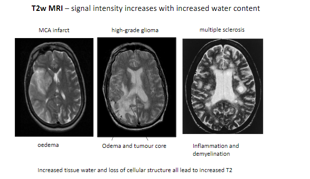 <p>MCA infarct (Middle Cerebral Artery infarction).</p><p>High-grade glioma.</p><p>Multiple sclerosis.</p><p>Edema.</p><p>Inflammation and demyelination.</p>