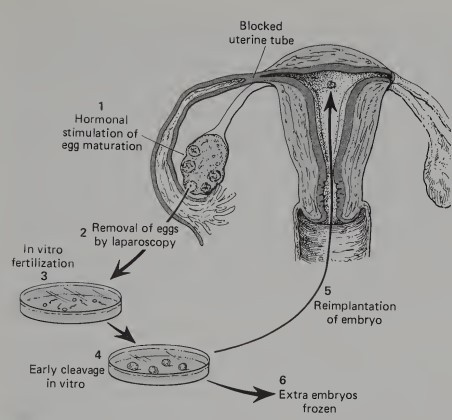 <p>A technique that allowed childless couples to have children from their own genetic heritage. It is used in cases where both the mother and father are capable of producing viable eggs and sperm cells, but because of a blockage in the women’s uterine tubes the ovulated eggs are unable to be fertilized in her body and then become transported to her uterus</p>